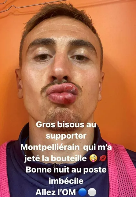 Валентен Ронжье после попадания бутылкой в Монпелье